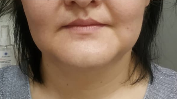 После — коррекция подбородка