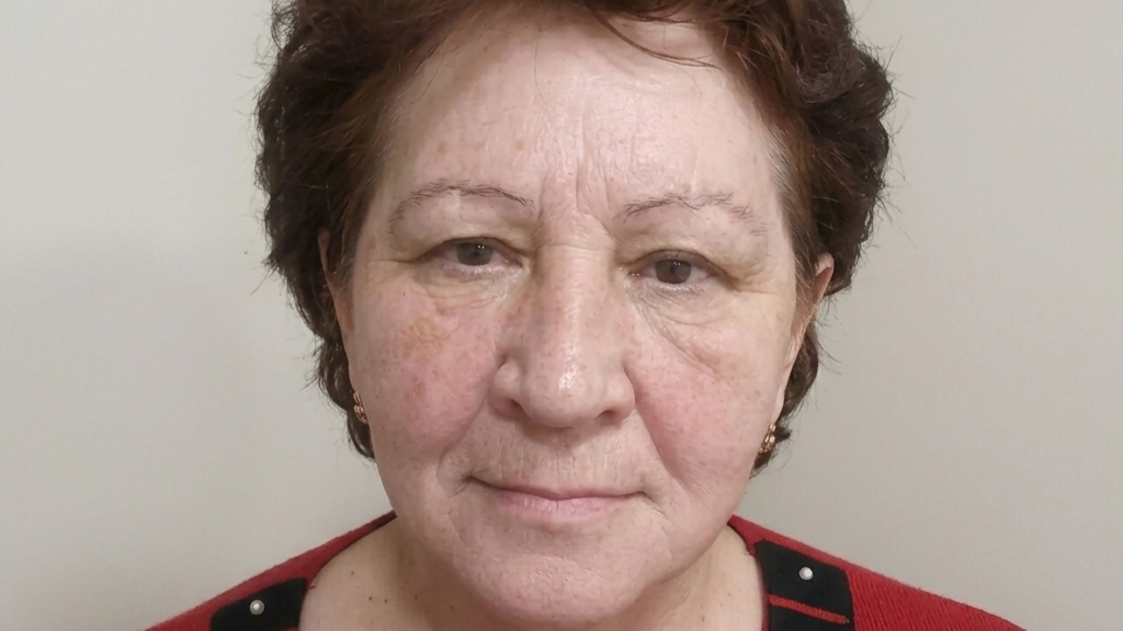 После — омоложение лица